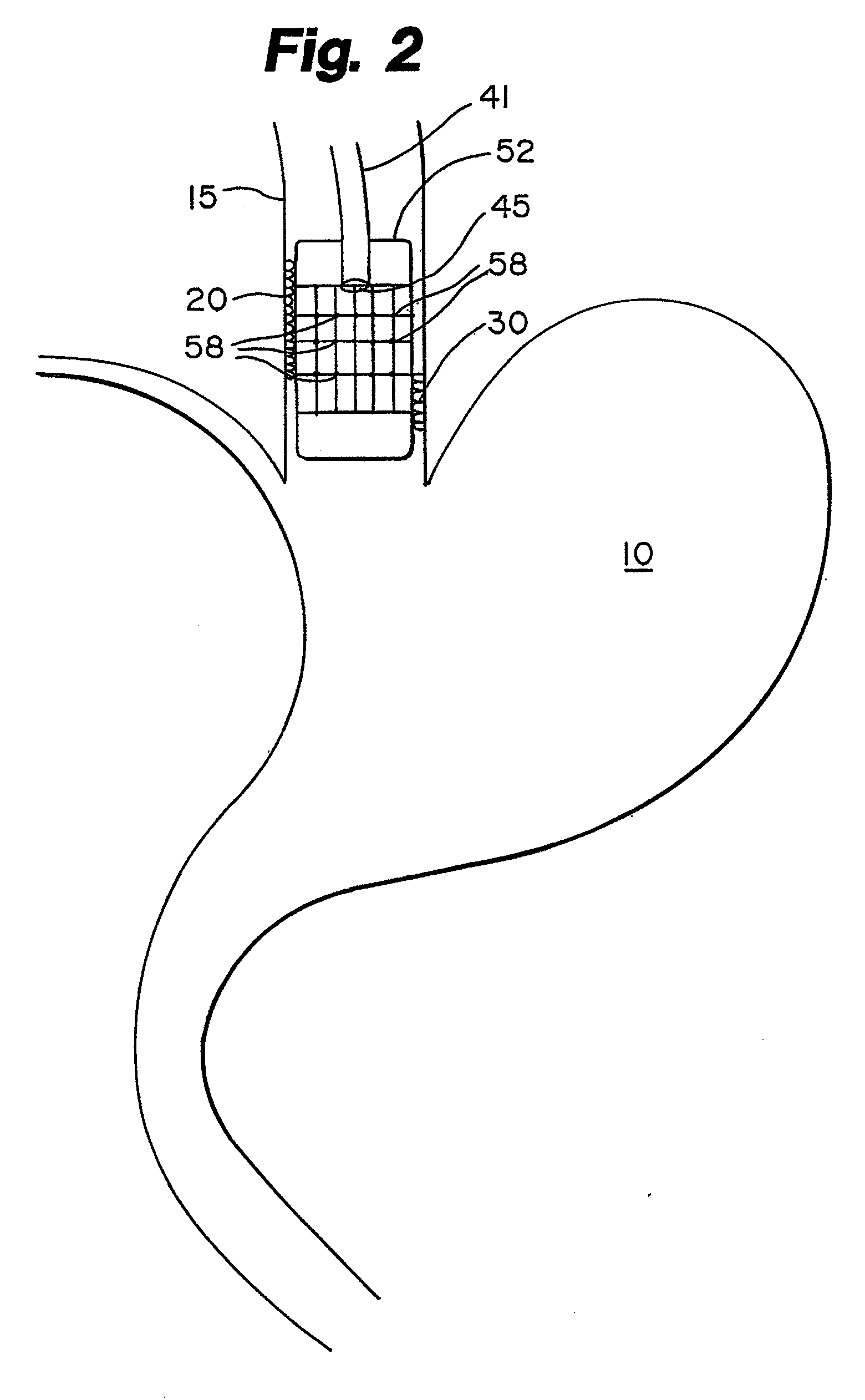 System and method of treating abnormal tissue in the human esophagus