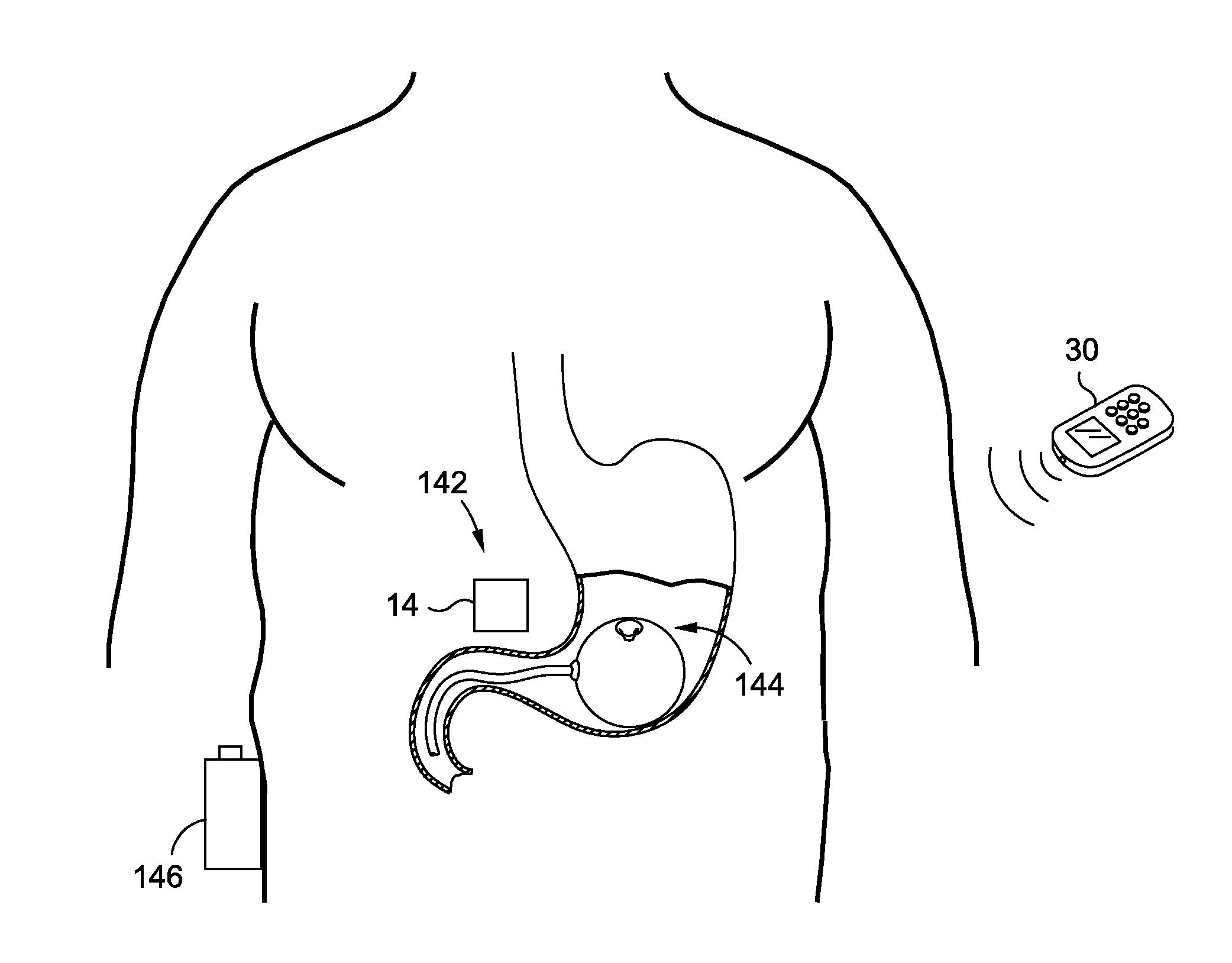 Intragastric volume occupying device with active agents