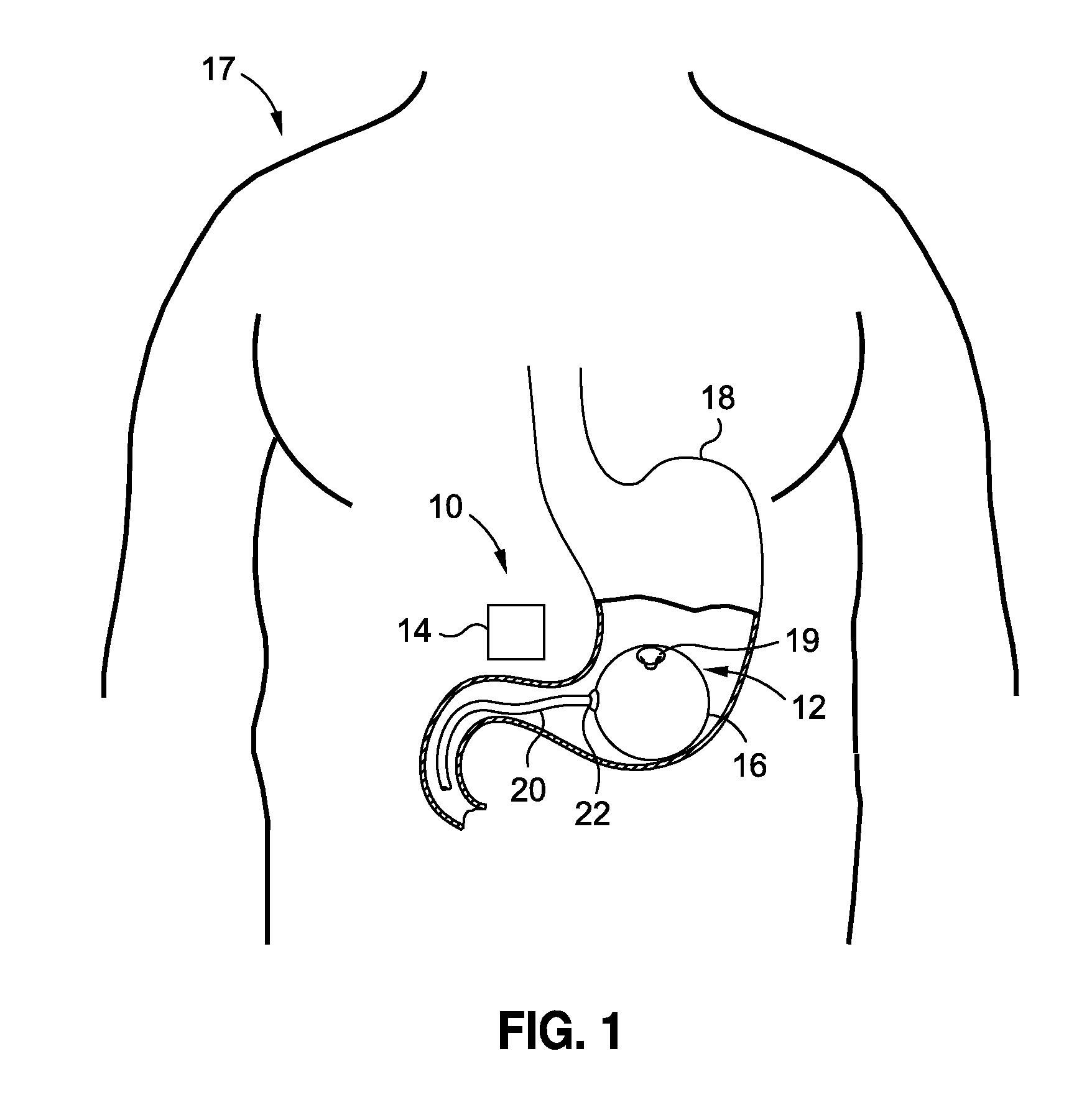 Intragastric volume occupying device with active agents