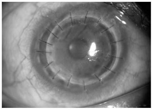 Kit and method for detecting CMV infection in trace biological sample of eye