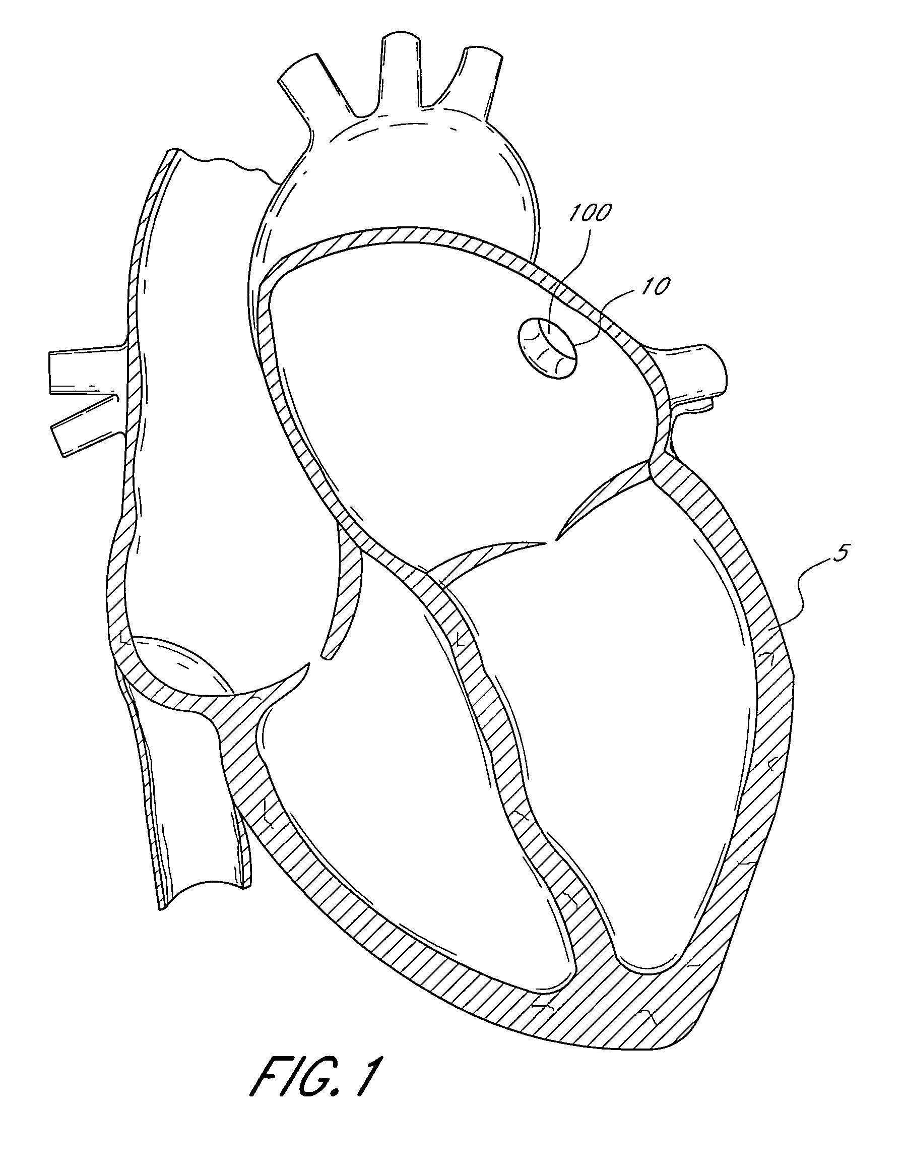 Method and apparatus for recapturing an implant from the left atrial appendage