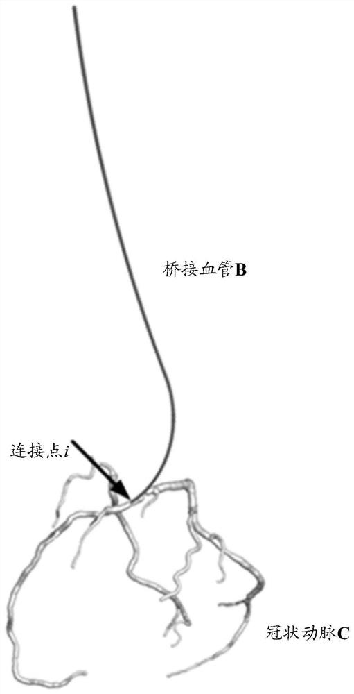 Method, device, electronic equipment and computer storage medium for determining blood flow