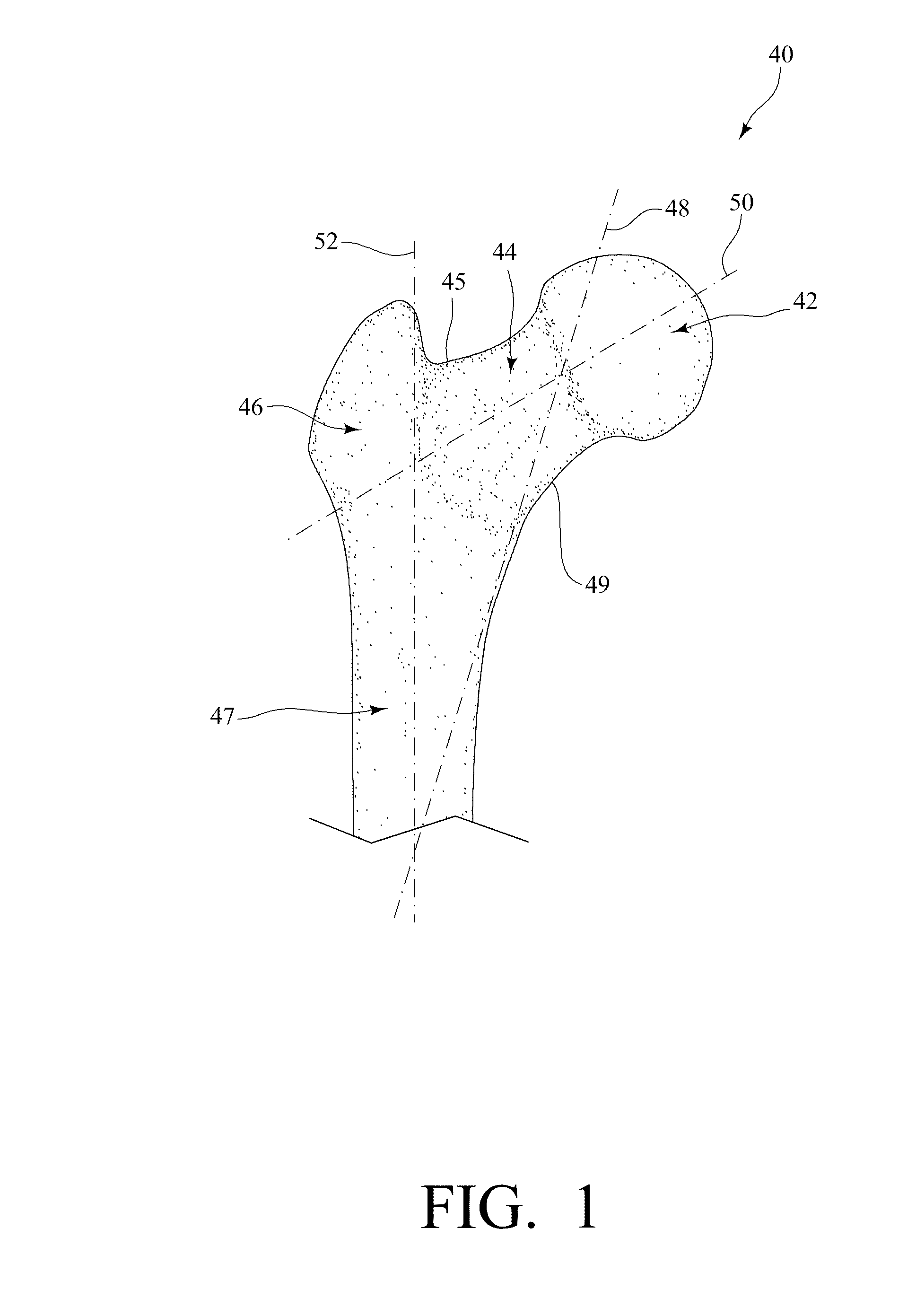 Device and method to prevent hip fractures