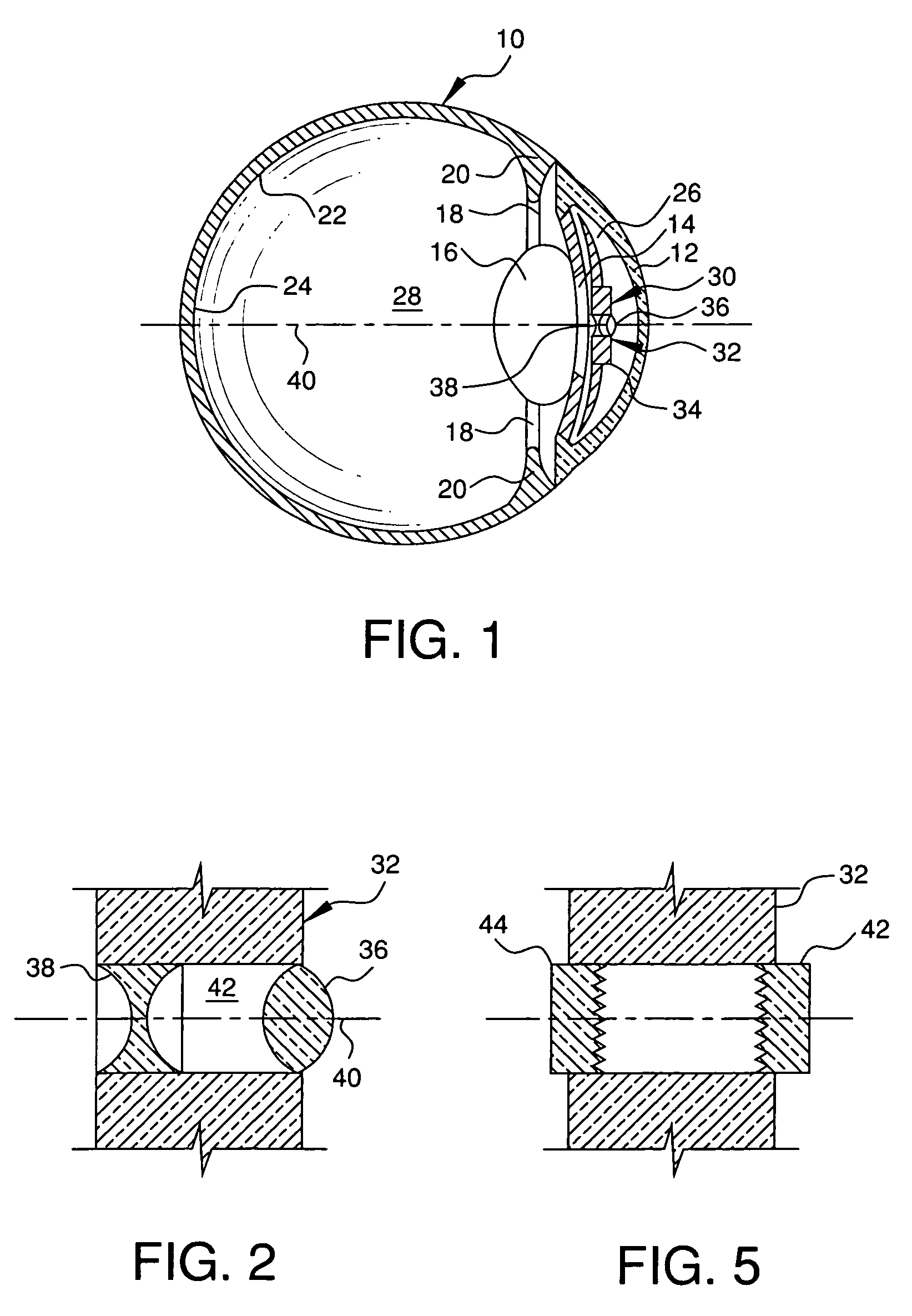 Bifocal intraocular telescope for low vision correction