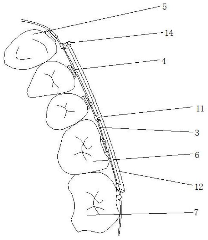 Auxiliary device for molar distal movement