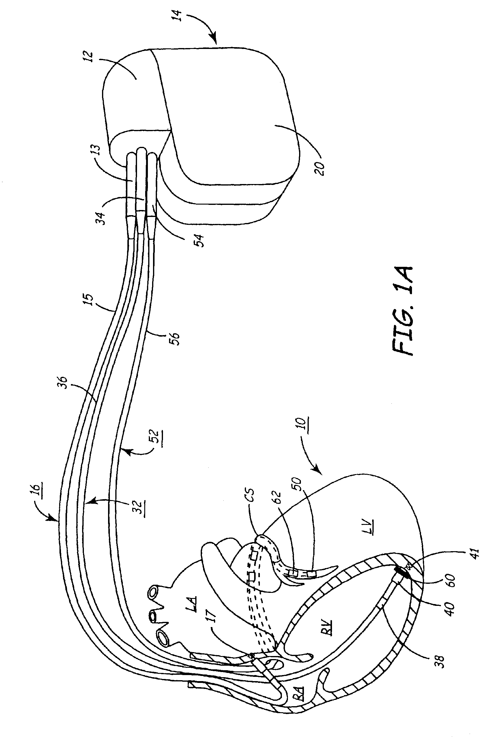 Method and apparatus for optimizing cardiac resynchronization therapy based on left ventricular acceleration