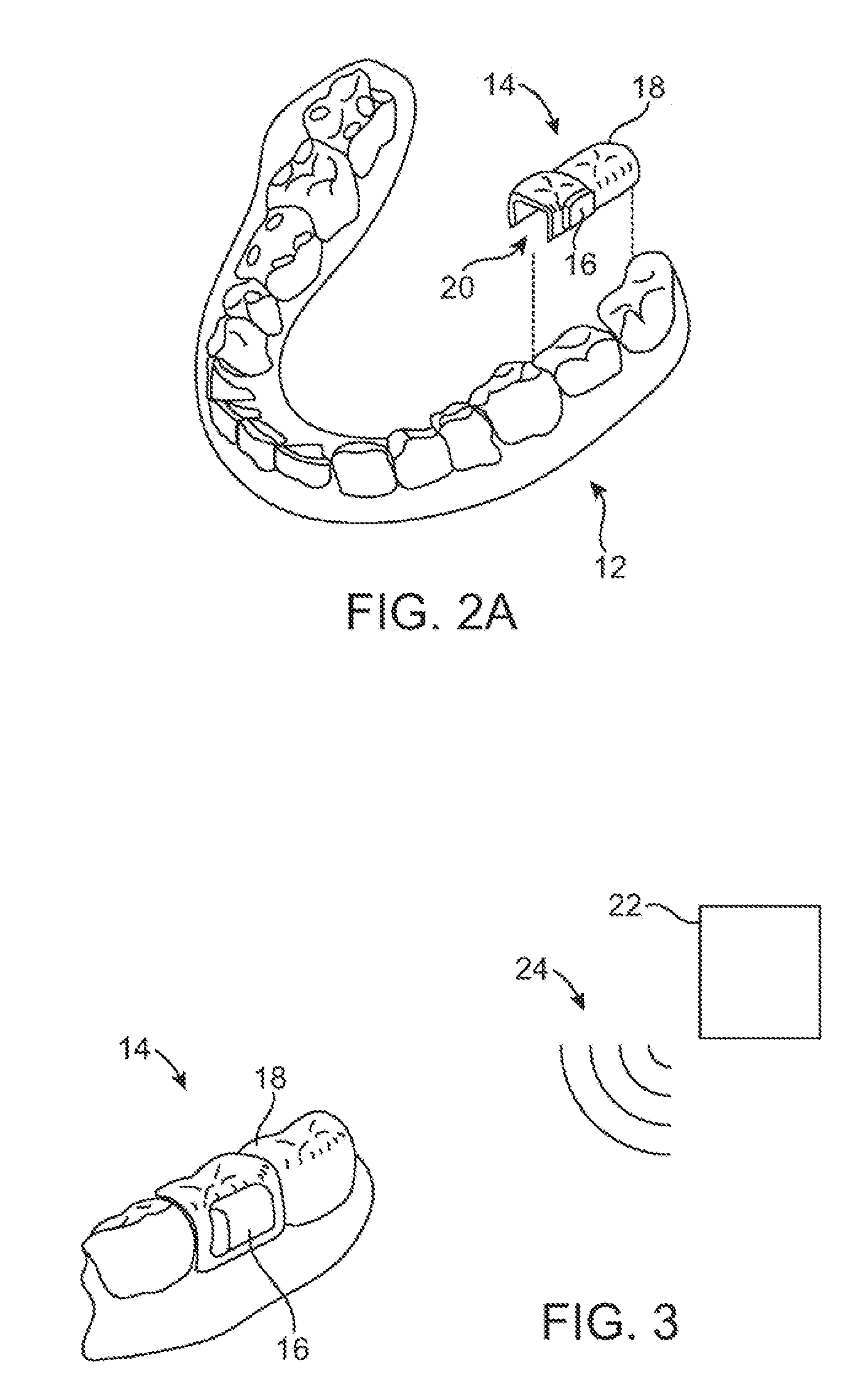 Stuttering treatment methods and apparatus