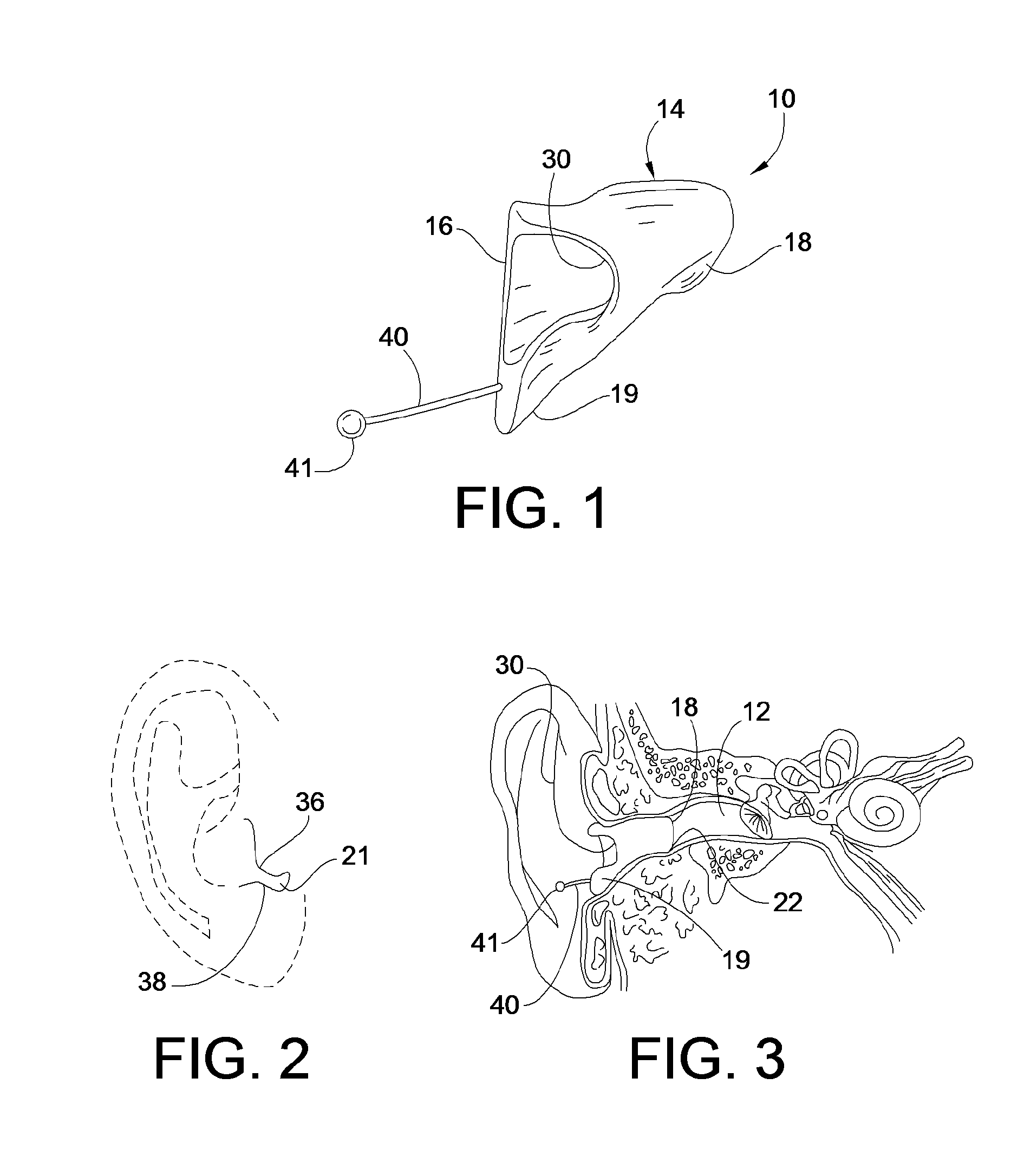 Method for Treating Headaches with Intra-Aural Devices