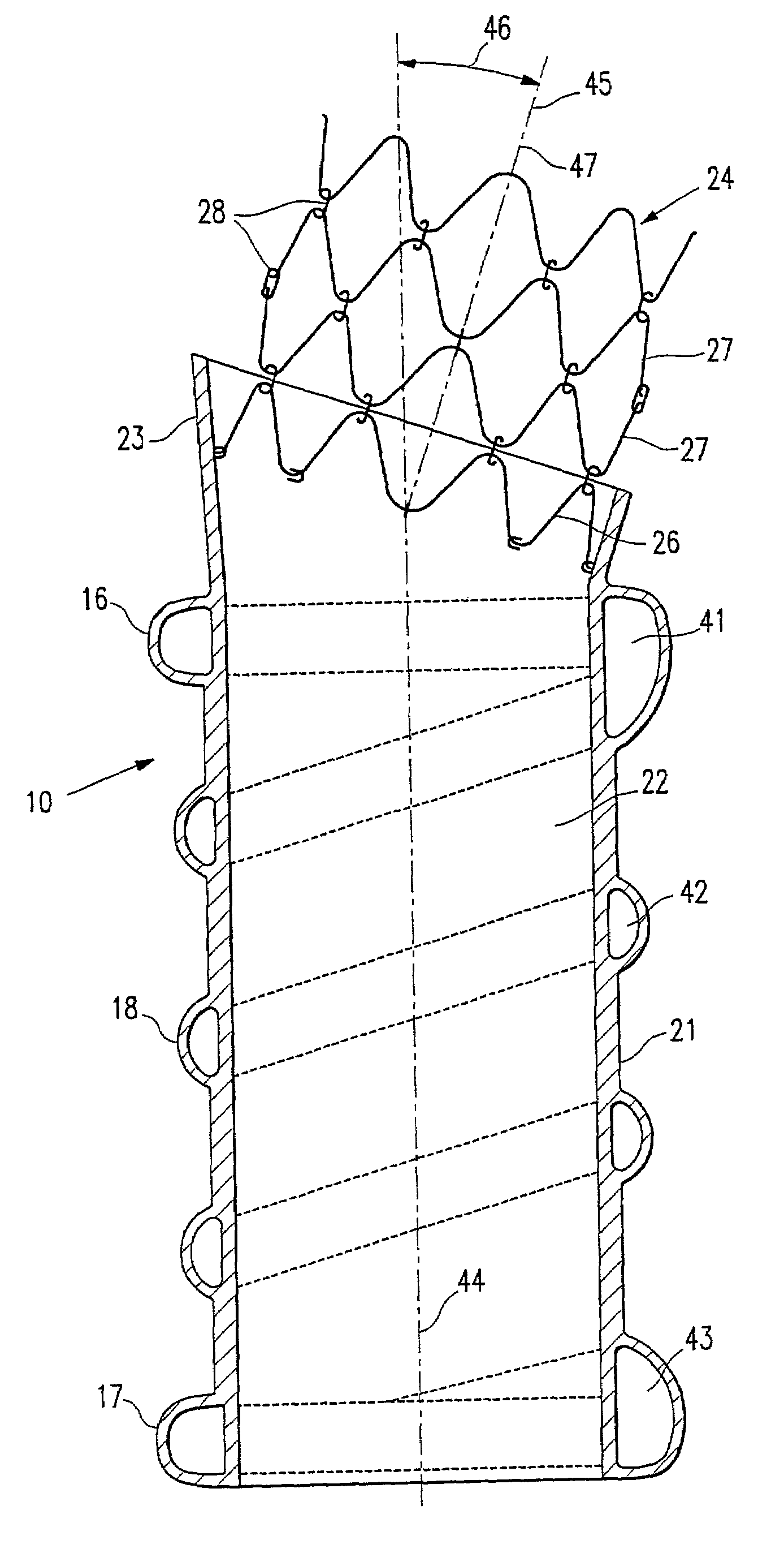 Endovascular graft