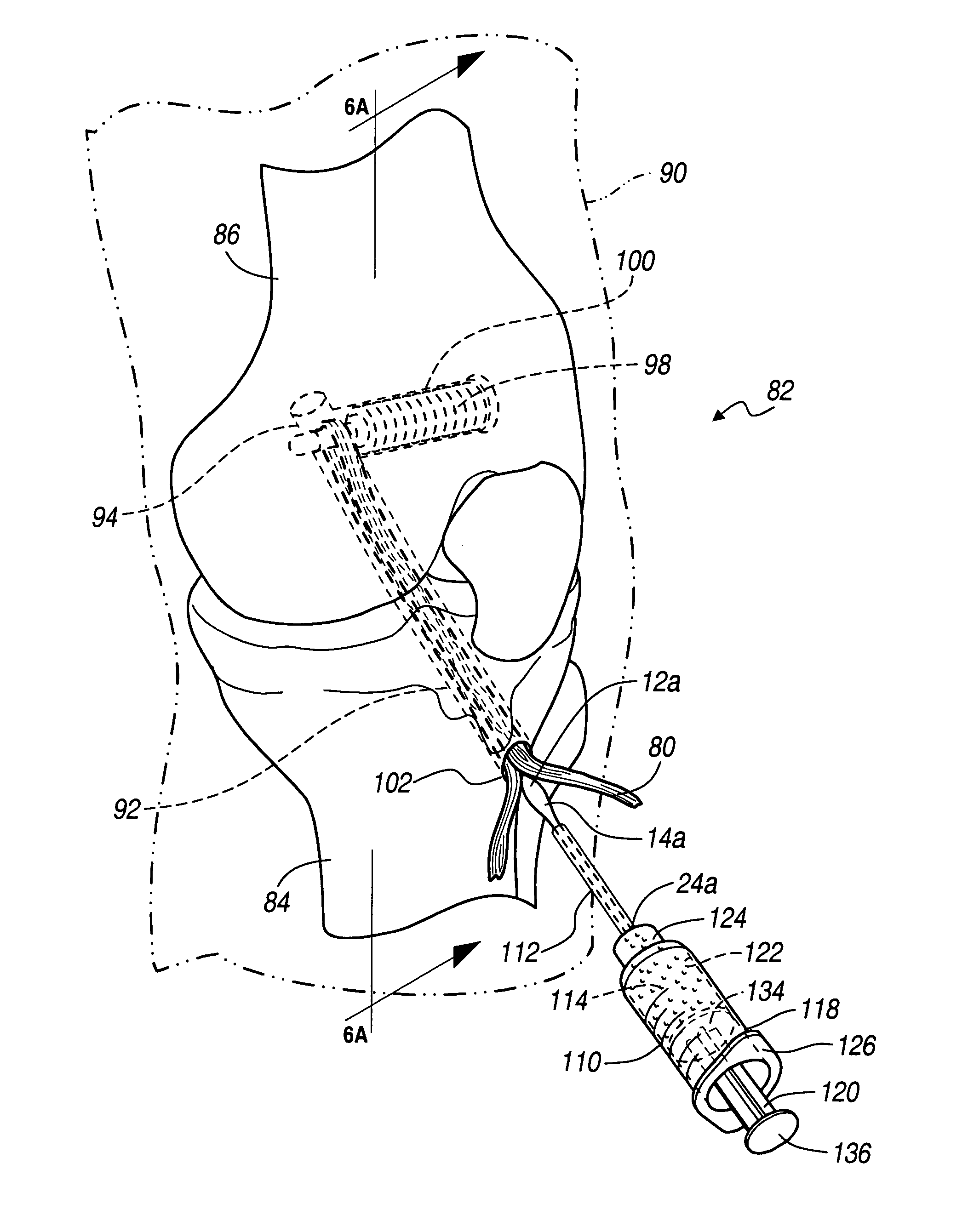Method and apparatus for securing soft tissue to bone
