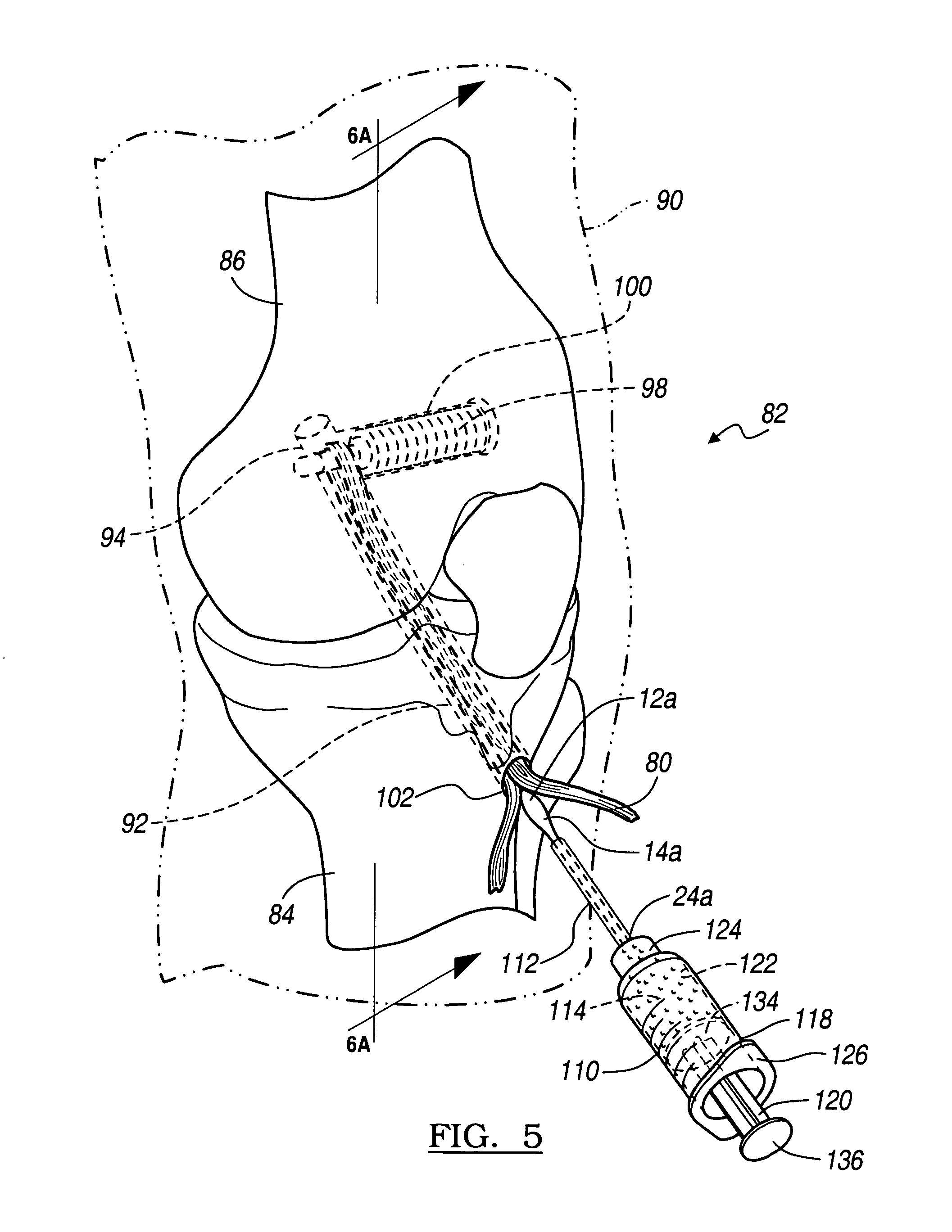 Method and apparatus for securing soft tissue to bone