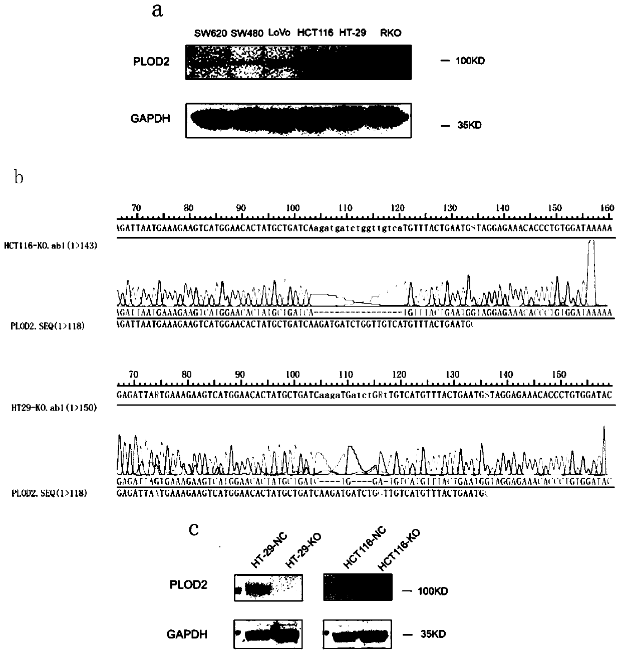 Application of small-molecule inhibitor minoxidil of PLOD2 in tumor treatment