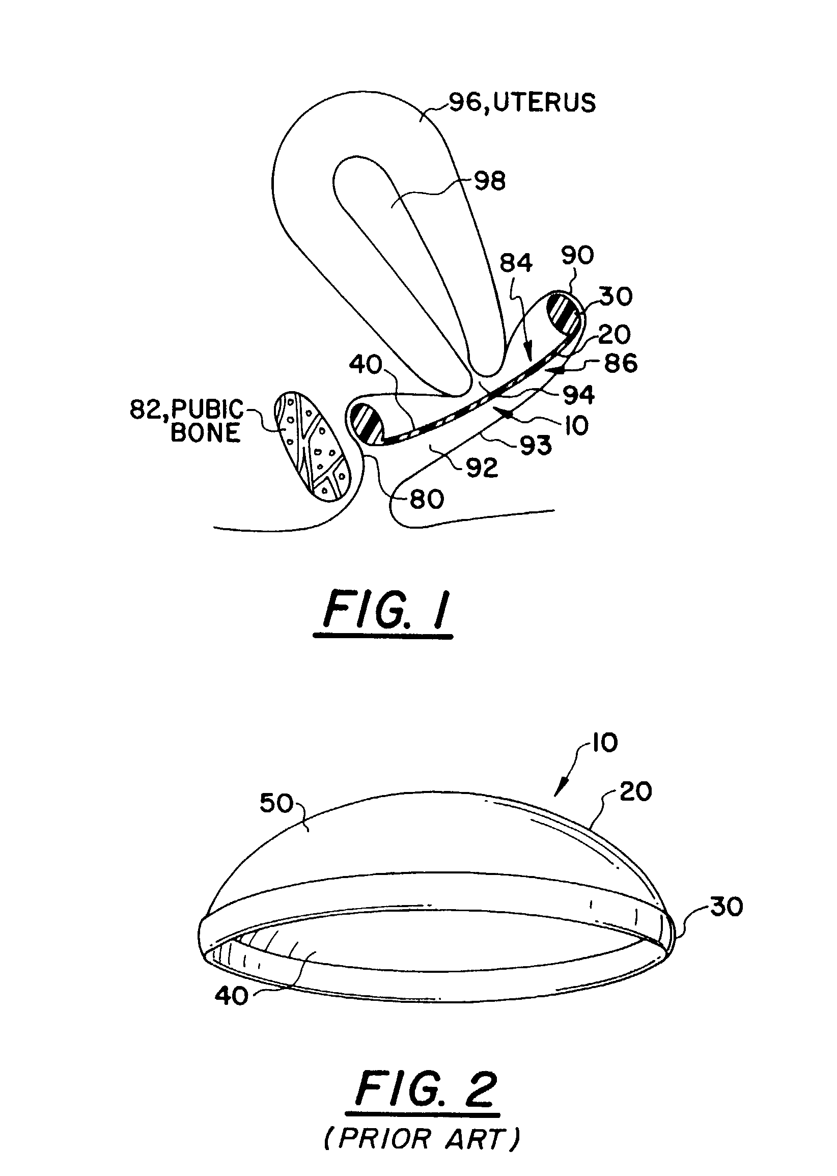 Device and method for simultaneously delivering beneficial agents to both cervical and vaginal lumen sides of a vagina