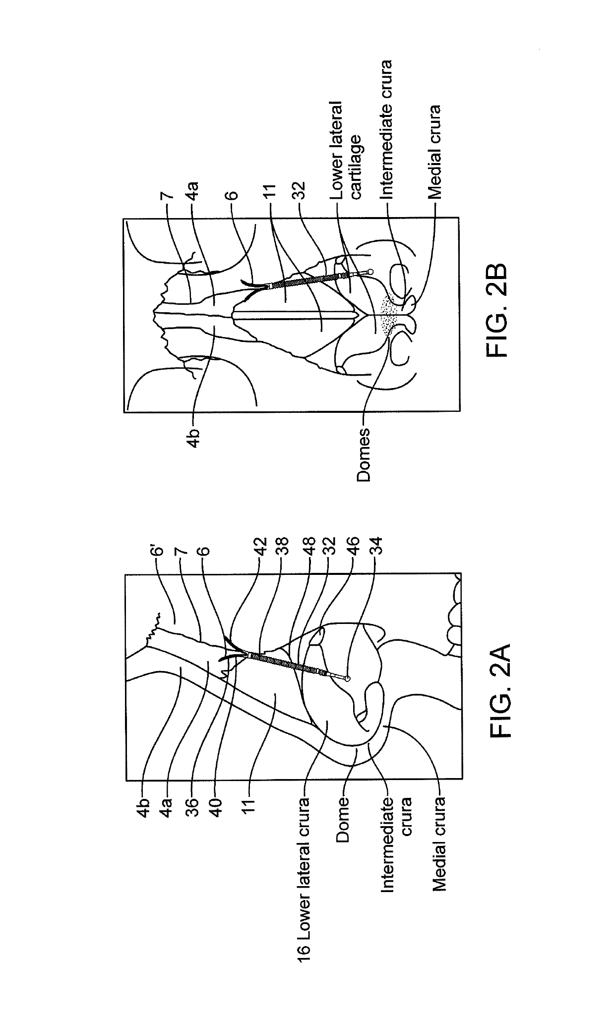 Nasal implants and systems and method of use