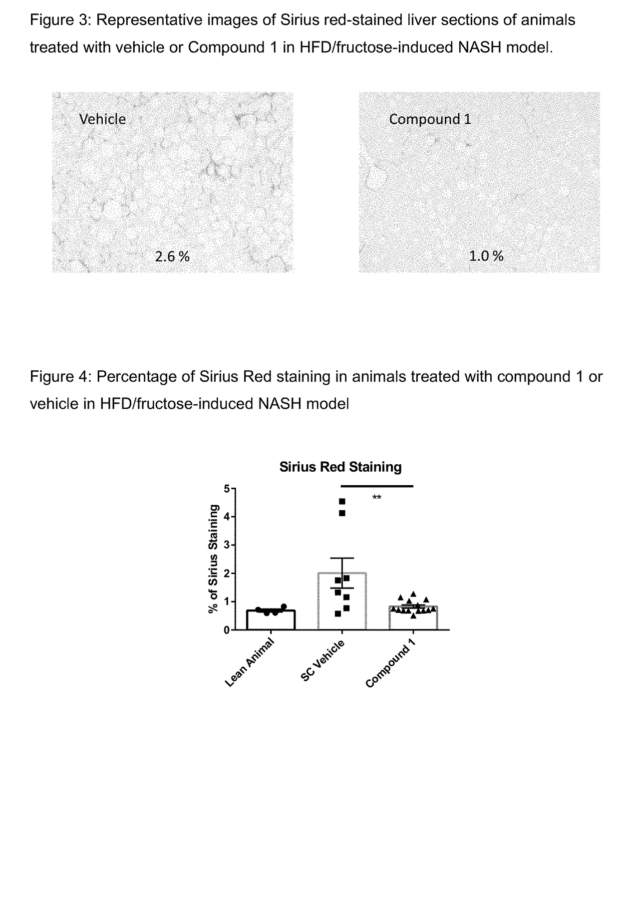 Method of treating liver fibrosis