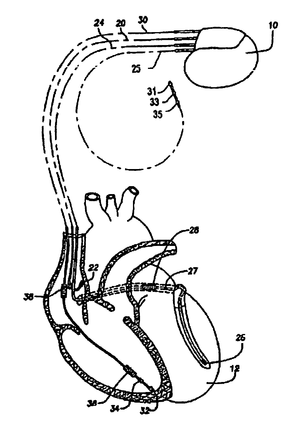 Methods and systems for detecting the presence of T-wave alternans