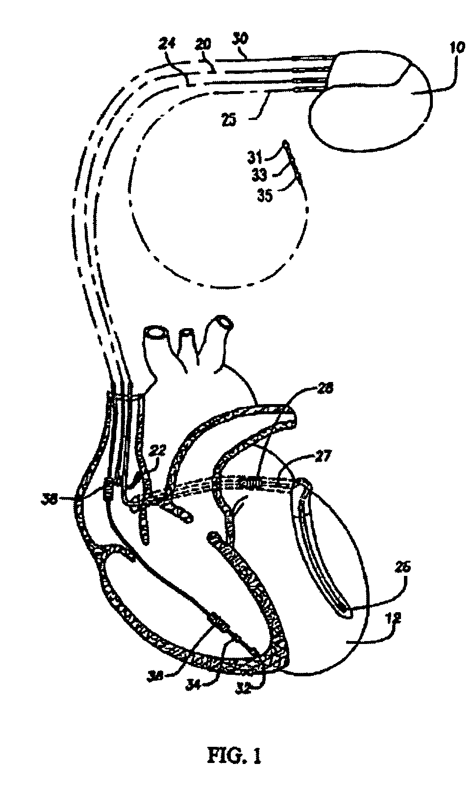 Methods and systems for detecting the presence of T-wave alternans