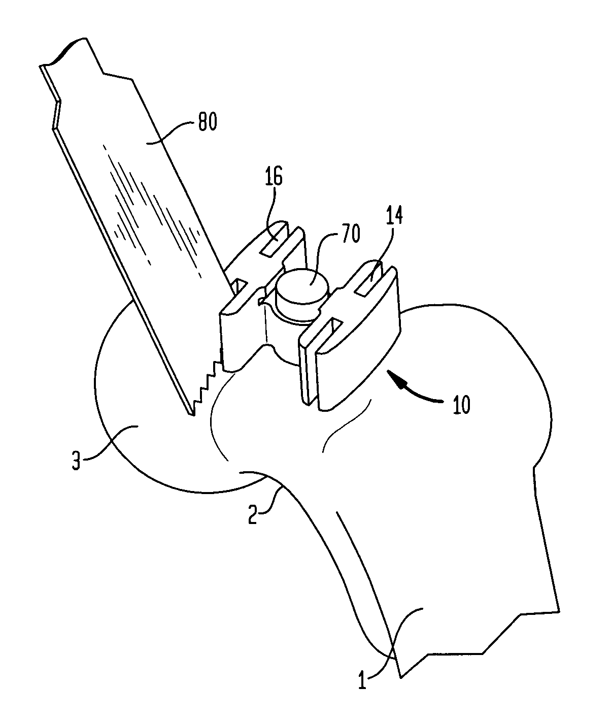 Navigated femoral neck resection guide and method