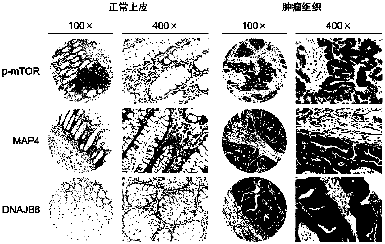 Application of protein marker or a combination thereof in prognosis judgment of colorectal cancer