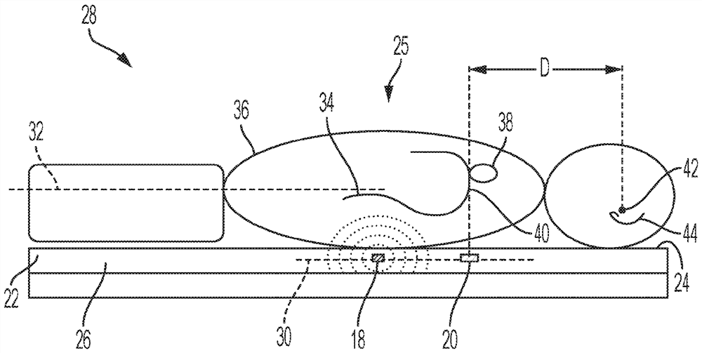 Compact antenna arrangement of radar system for detecting internal organ motion