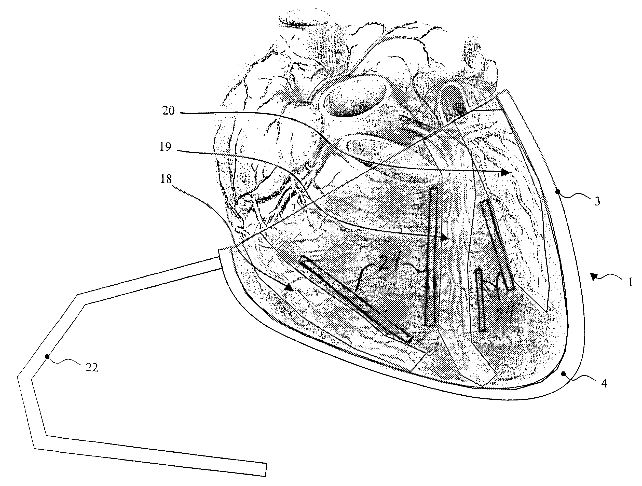 Device for the epicardial support and/or resumption of cardiac activity