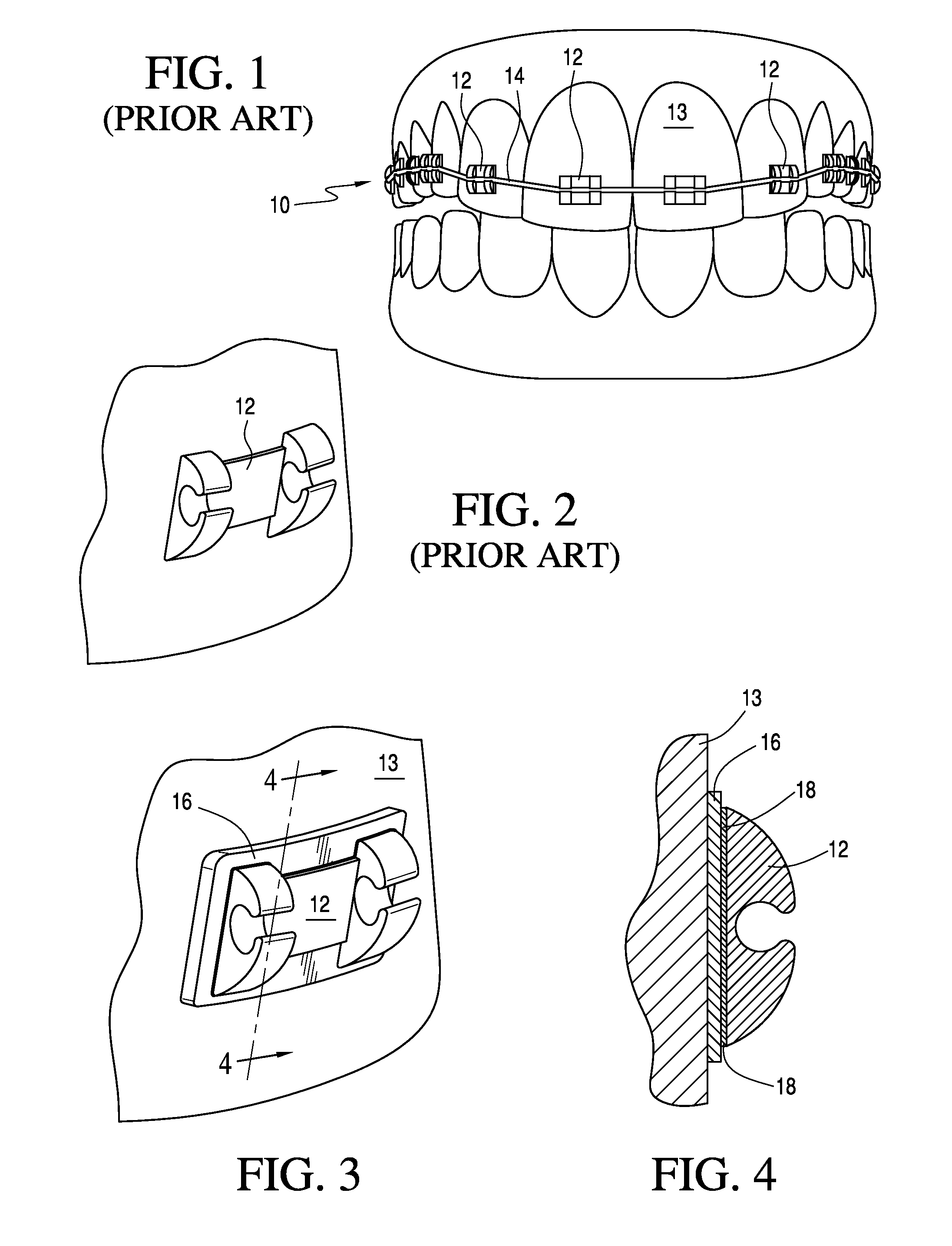 Adjustable orthodontic bracket and method using a microstructured shape memory polymer surface with reversible dry adhesion