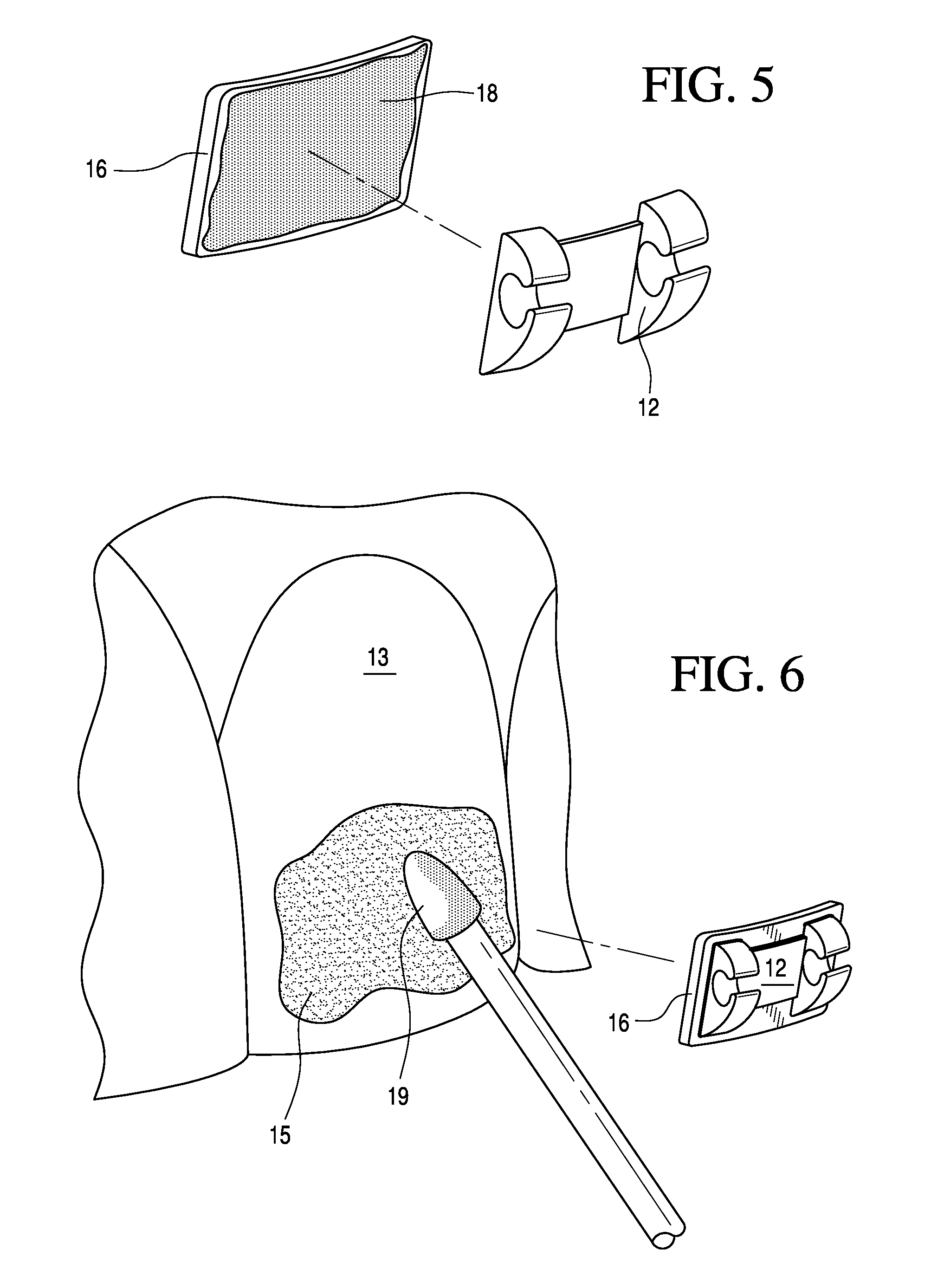 Adjustable orthodontic bracket and method using a microstructured shape memory polymer surface with reversible dry adhesion