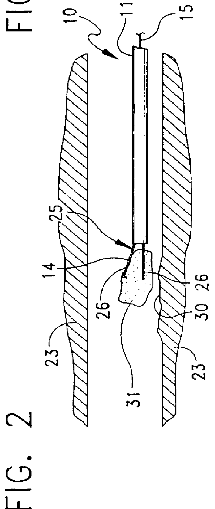 Method and apparatus for severing and capturing polyps