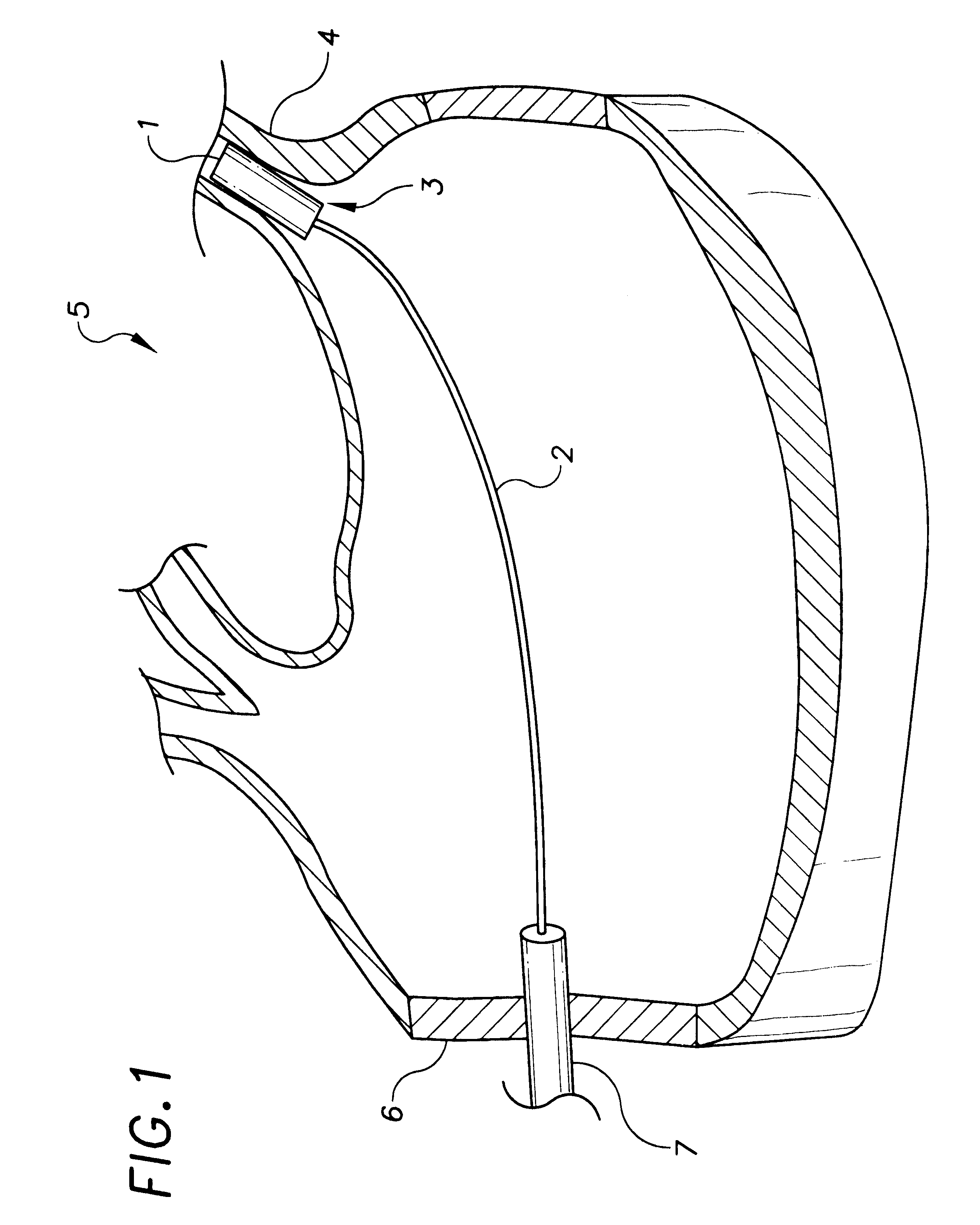 Pulmonary vein stent and method for use