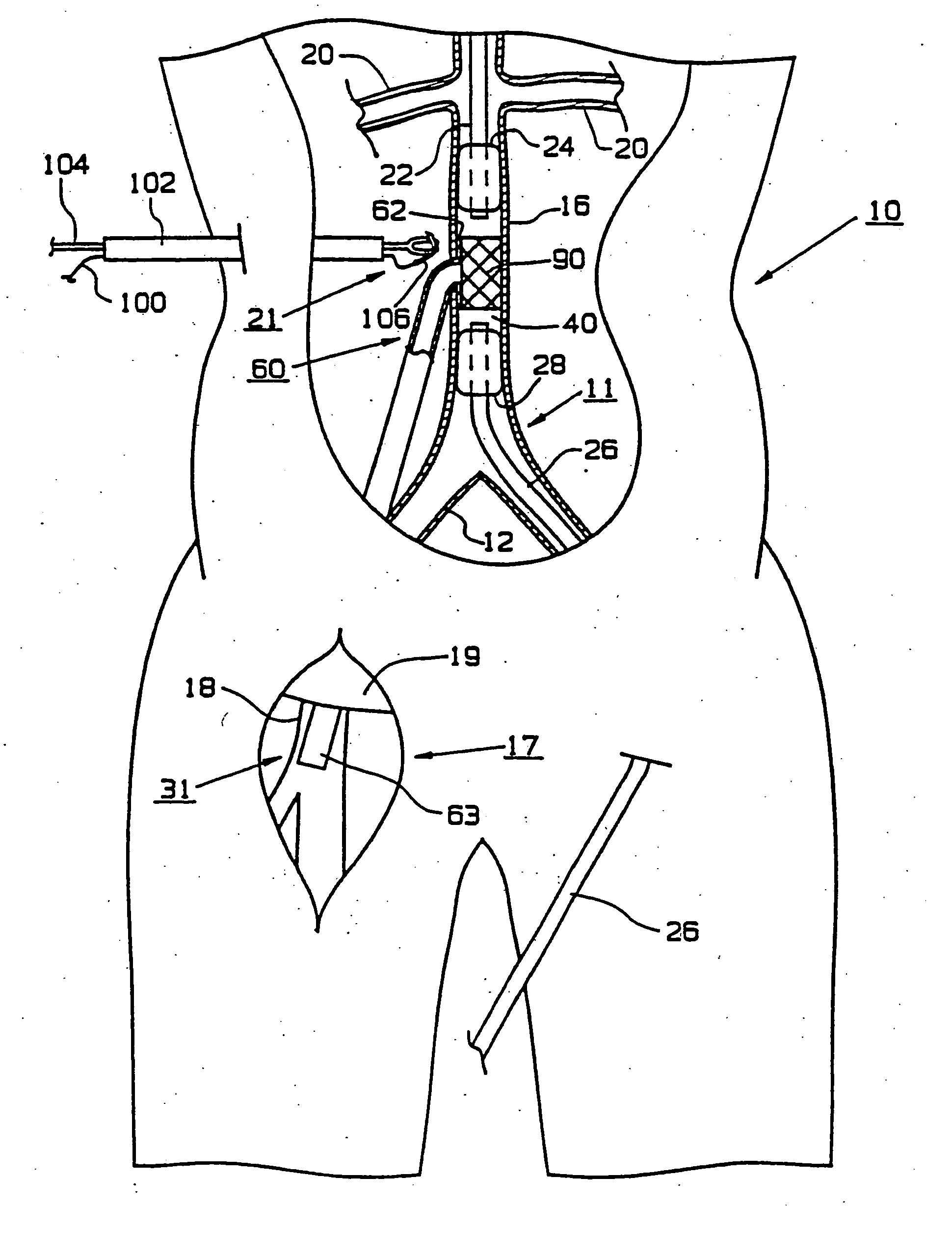 Endoscopic bypass grafting method utilizing an inguinal approach