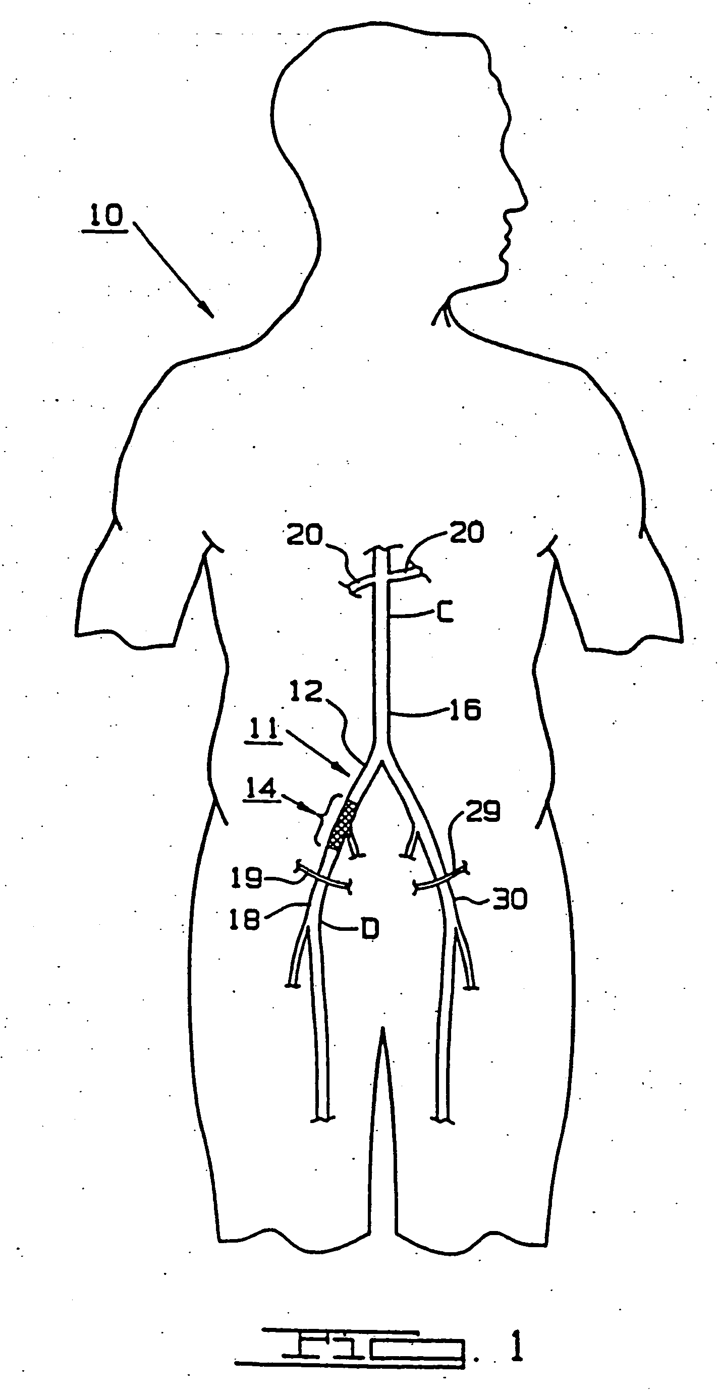 Endoscopic bypass grafting method utilizing an inguinal approach