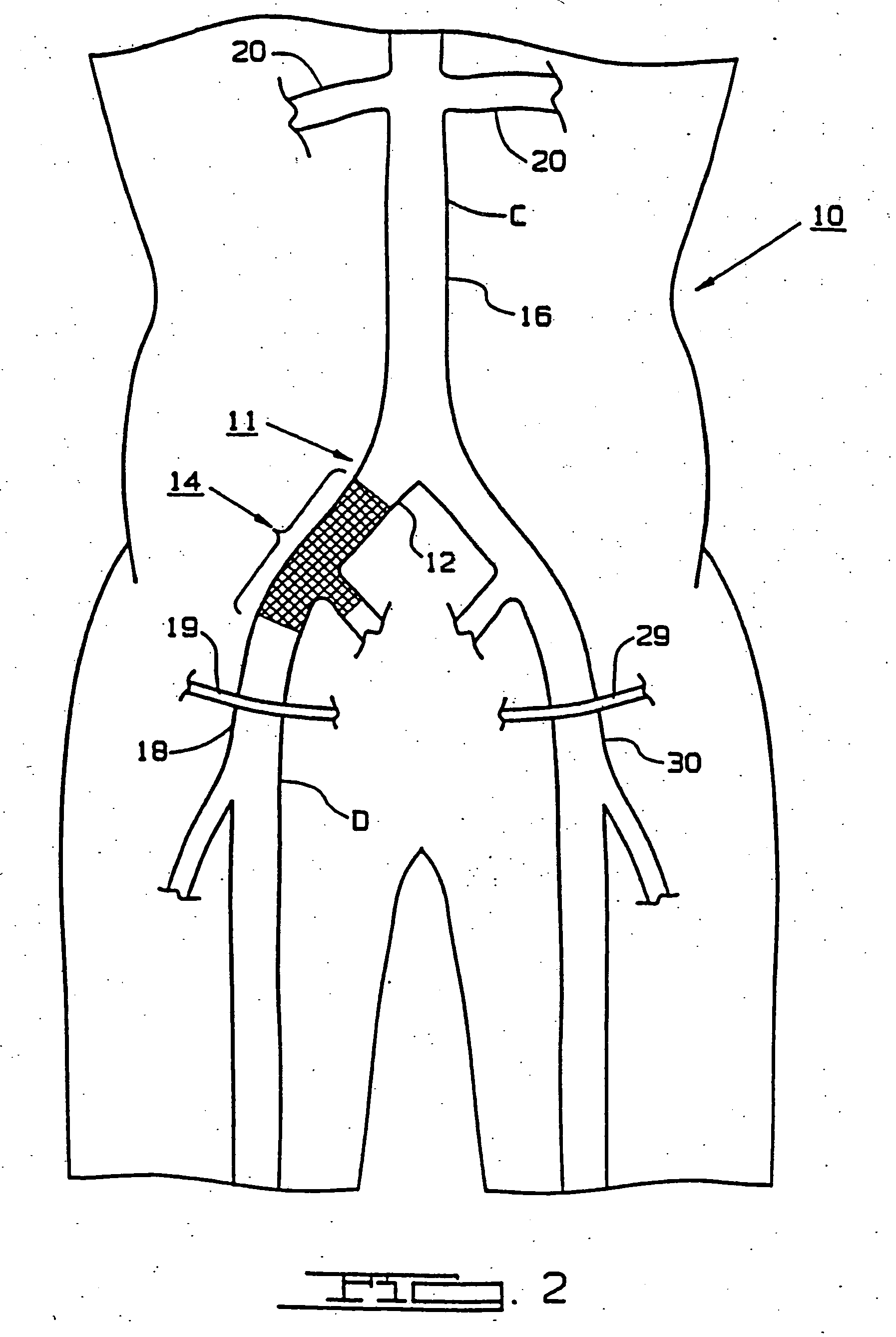 Endoscopic bypass grafting method utilizing an inguinal approach