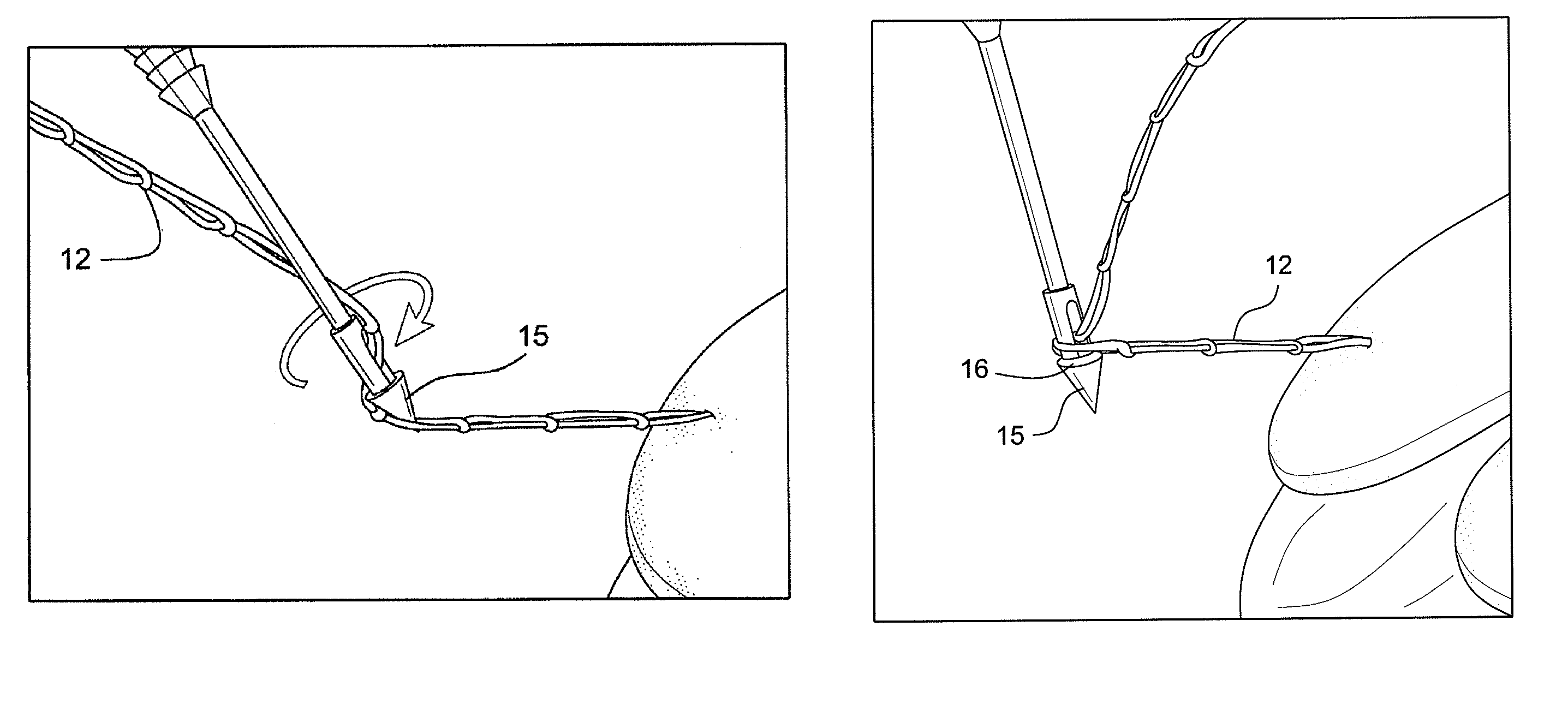 Technique for tissue fixation by capturing and anchoring a link of suture chain attached to tissue