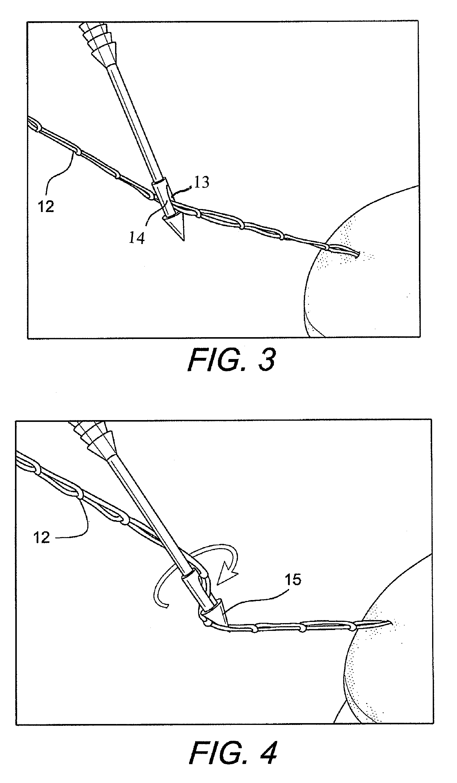 Technique for tissue fixation by capturing and anchoring a link of suture chain attached to tissue