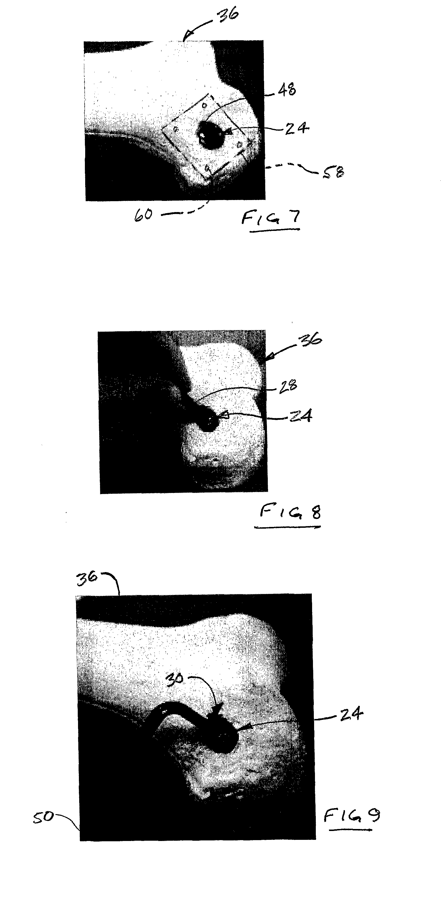 System and Method for Joint Restoration by Extracapsular Means