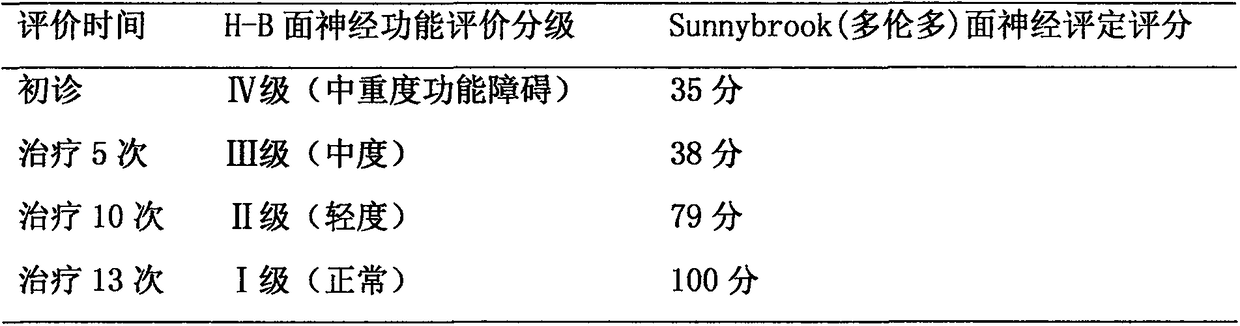 Traditional Chinese medicine composition for treating acute-stage wind-cold type peripheral facial paralysis and preparation method of traditional Chinese medicine composition