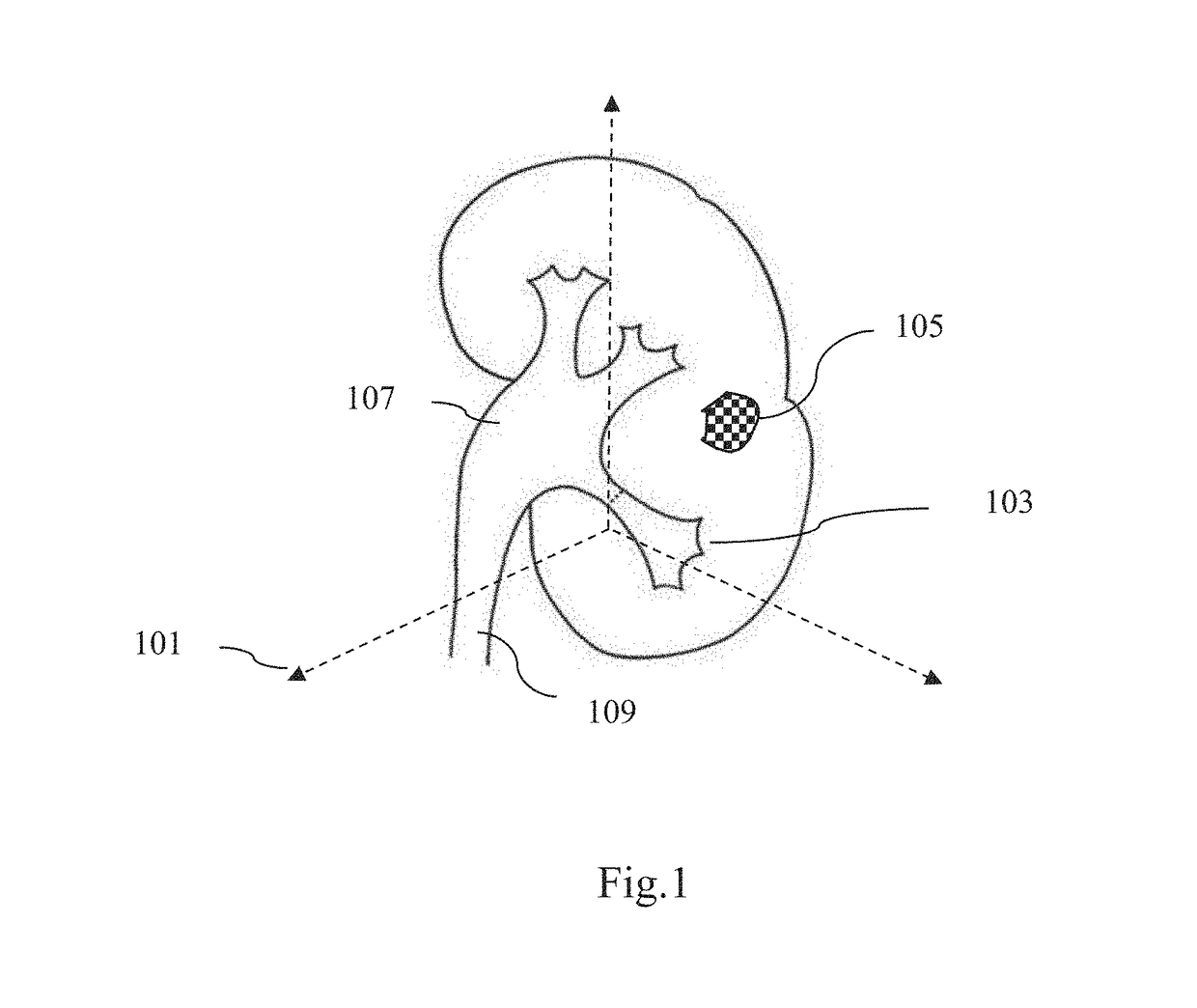 Method and system for interactive grid placement and measurements for lesion removal