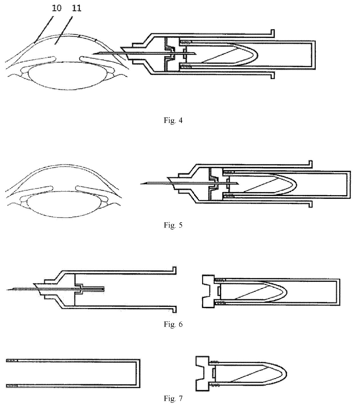 Disposable negative-pressure anterior chamber paracentesis syringe