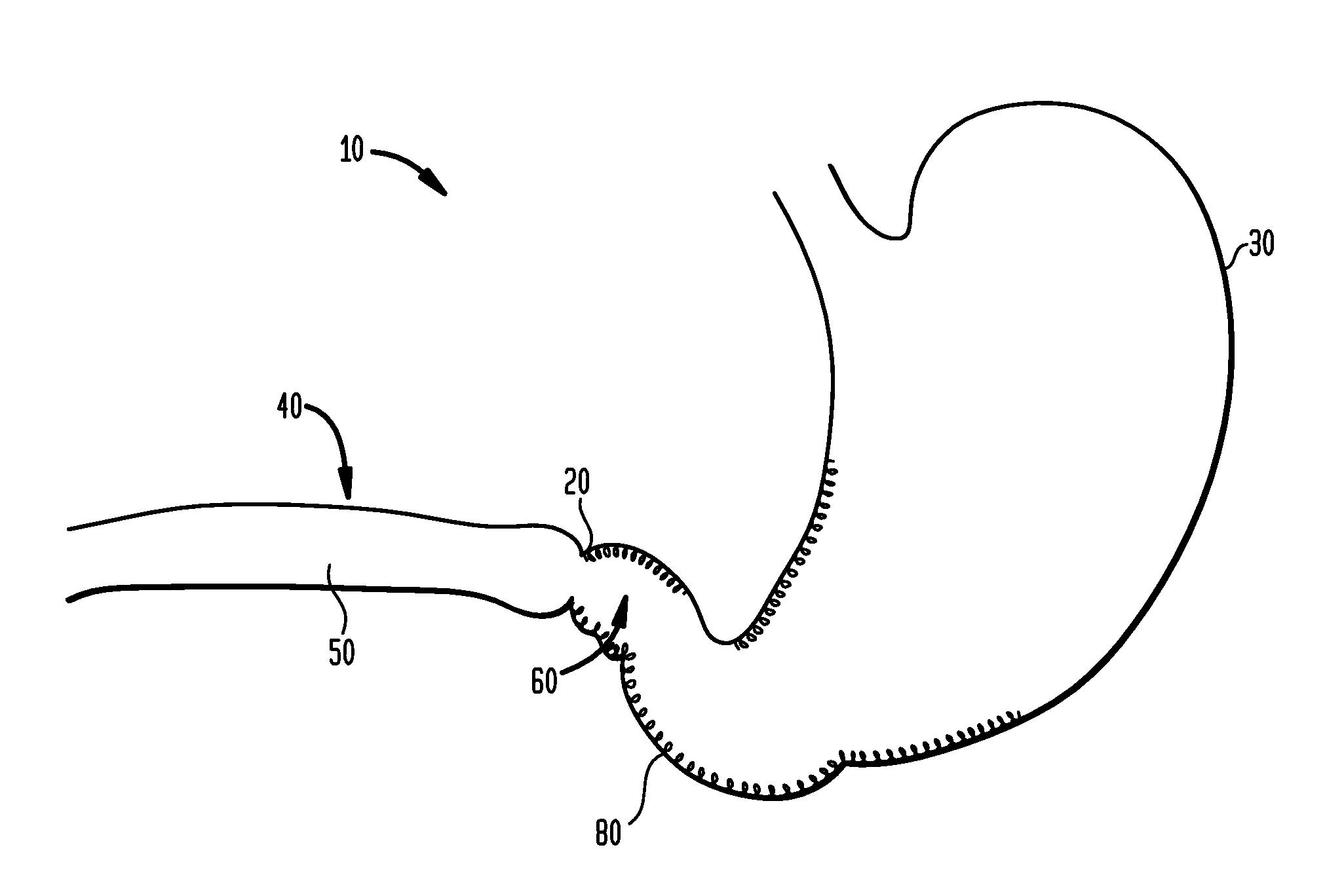 Systems and Methods for Treatment of Obesity and Type 2 Diabetes