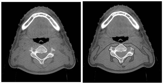 Method for evaluating skeletal muscle index of head and neck tumor patient through CBCT