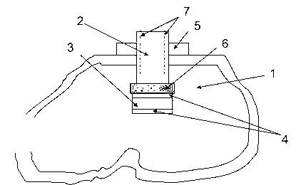 Tuning structure