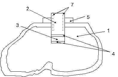 Tuning structure