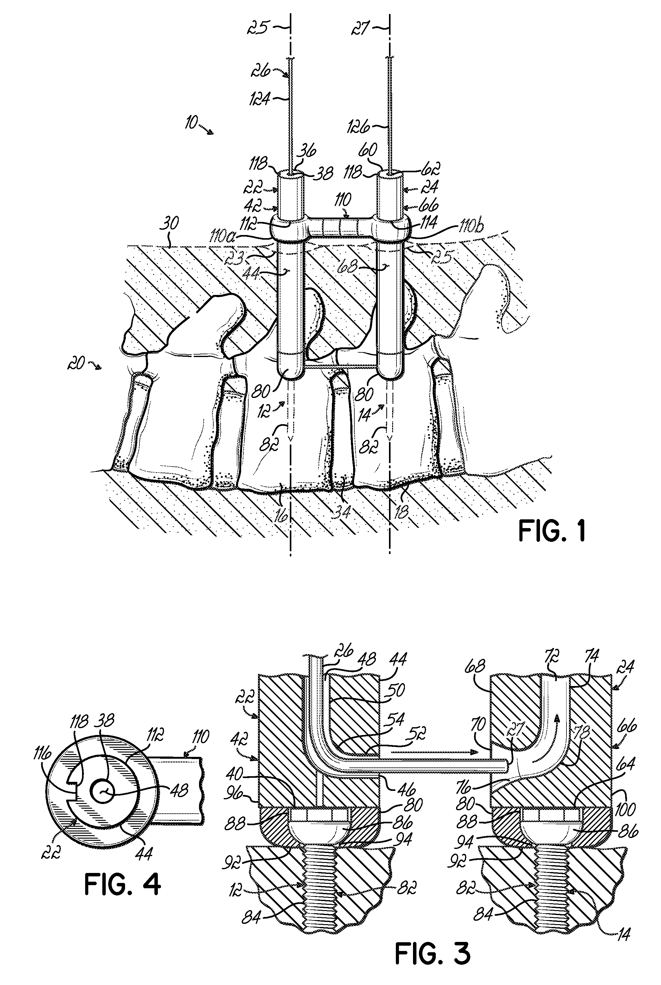 System and method for minimally invasive spinal surgery