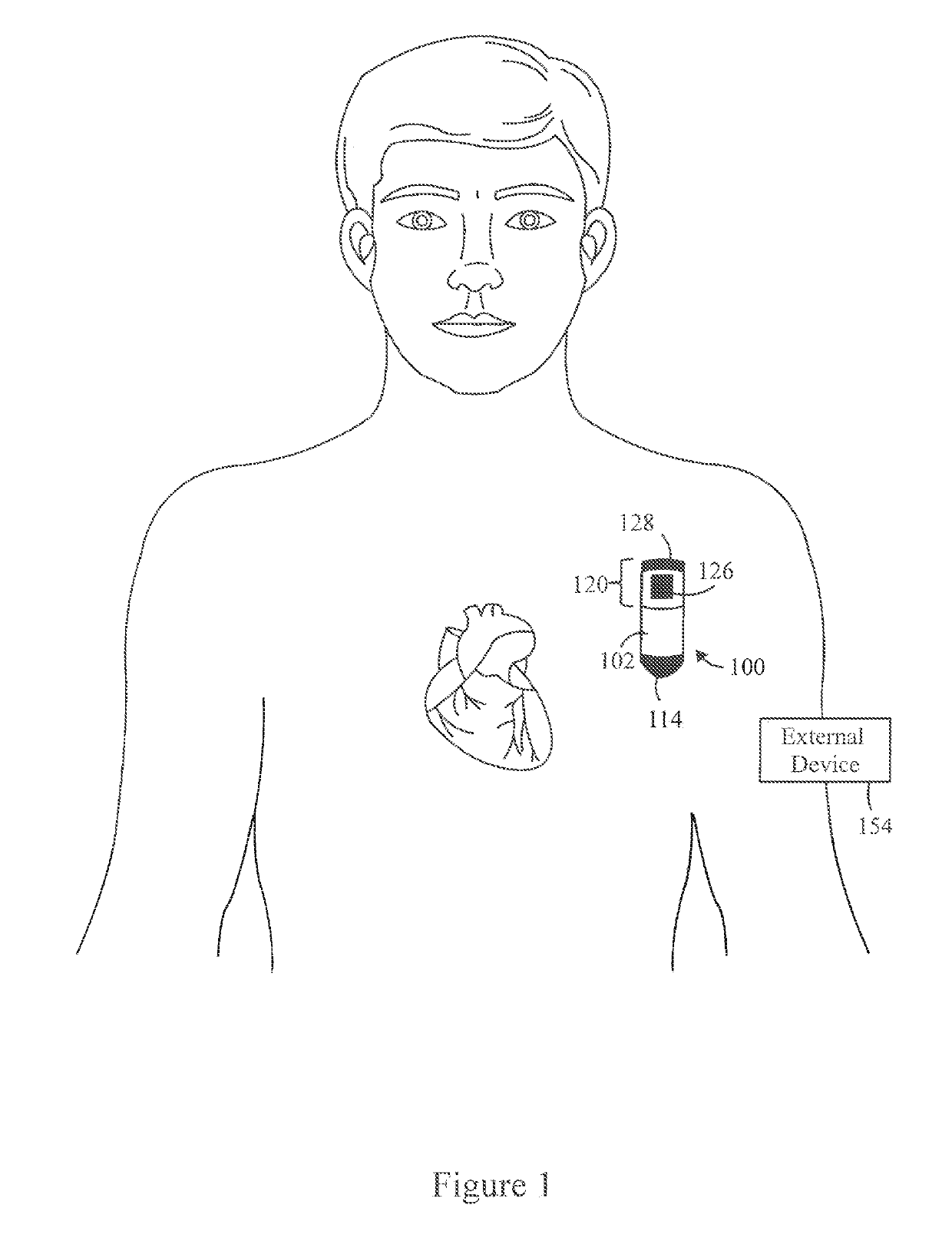 Method And System For Second Pass Confirmation Of Detected Cardiac Arrhythmic Patterns