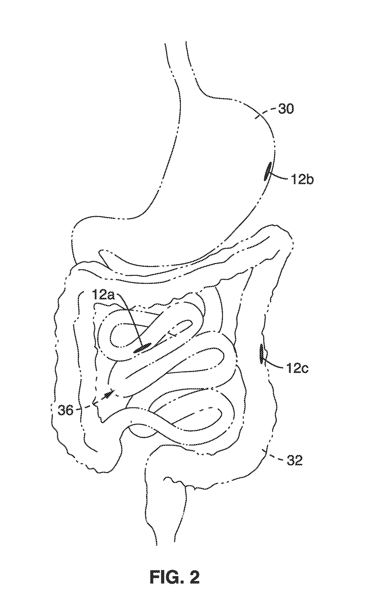 Disposable gastrointestinal implantable stimulator