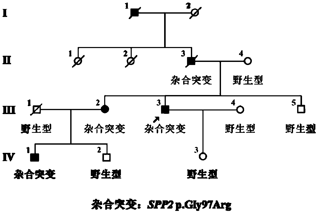 A pathogenic mutation of hereditary retinitis pigmentosa and its detection reagent