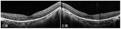 A pathogenic mutation of hereditary retinitis pigmentosa and its detection reagent