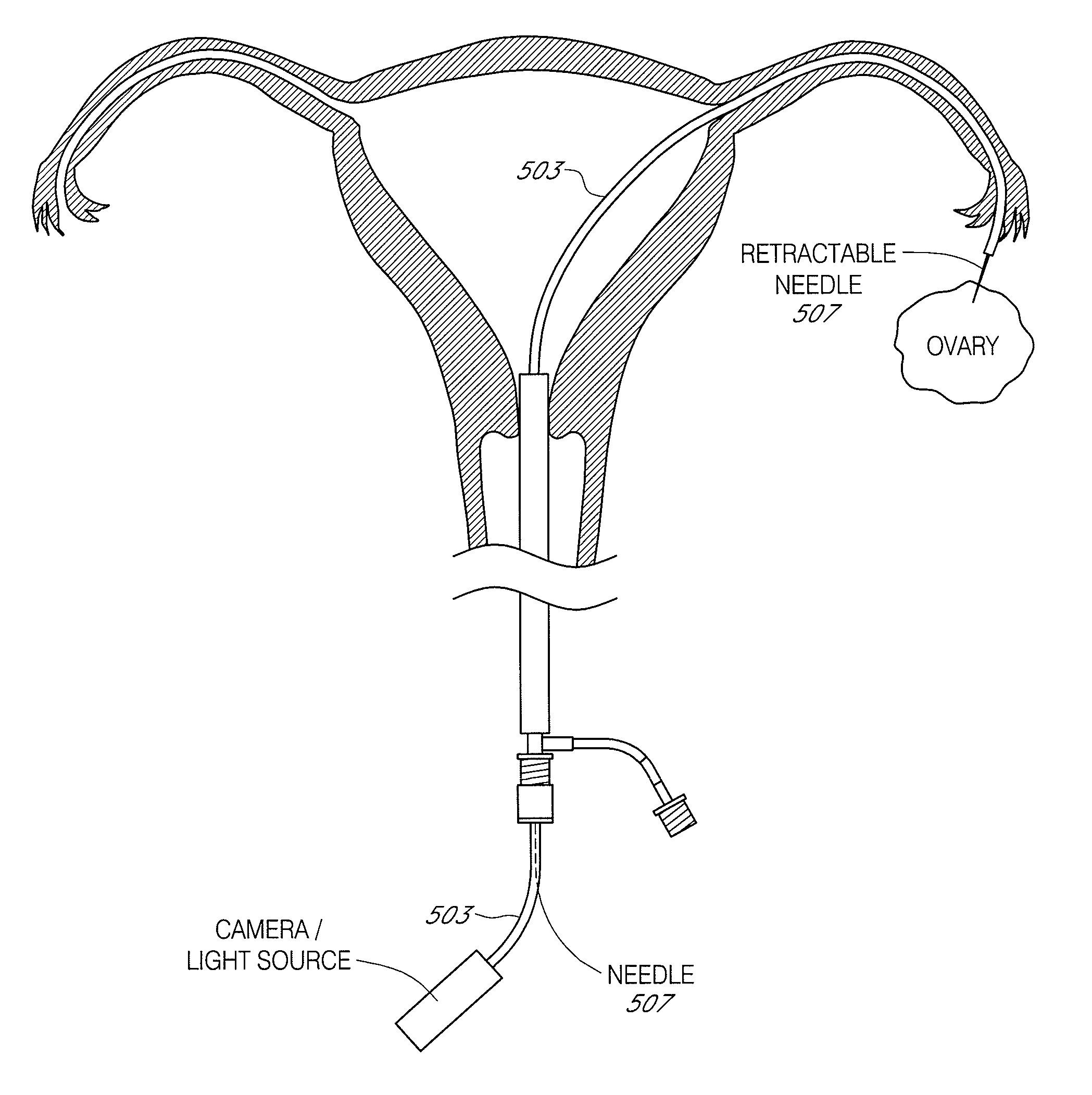 Methods, systems and devices for performing gynecological procedures
