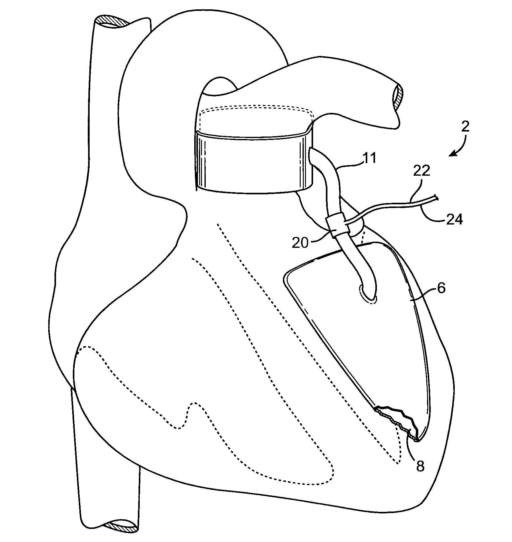 Devices and methods for absorbing, transferring and delivering heart energy