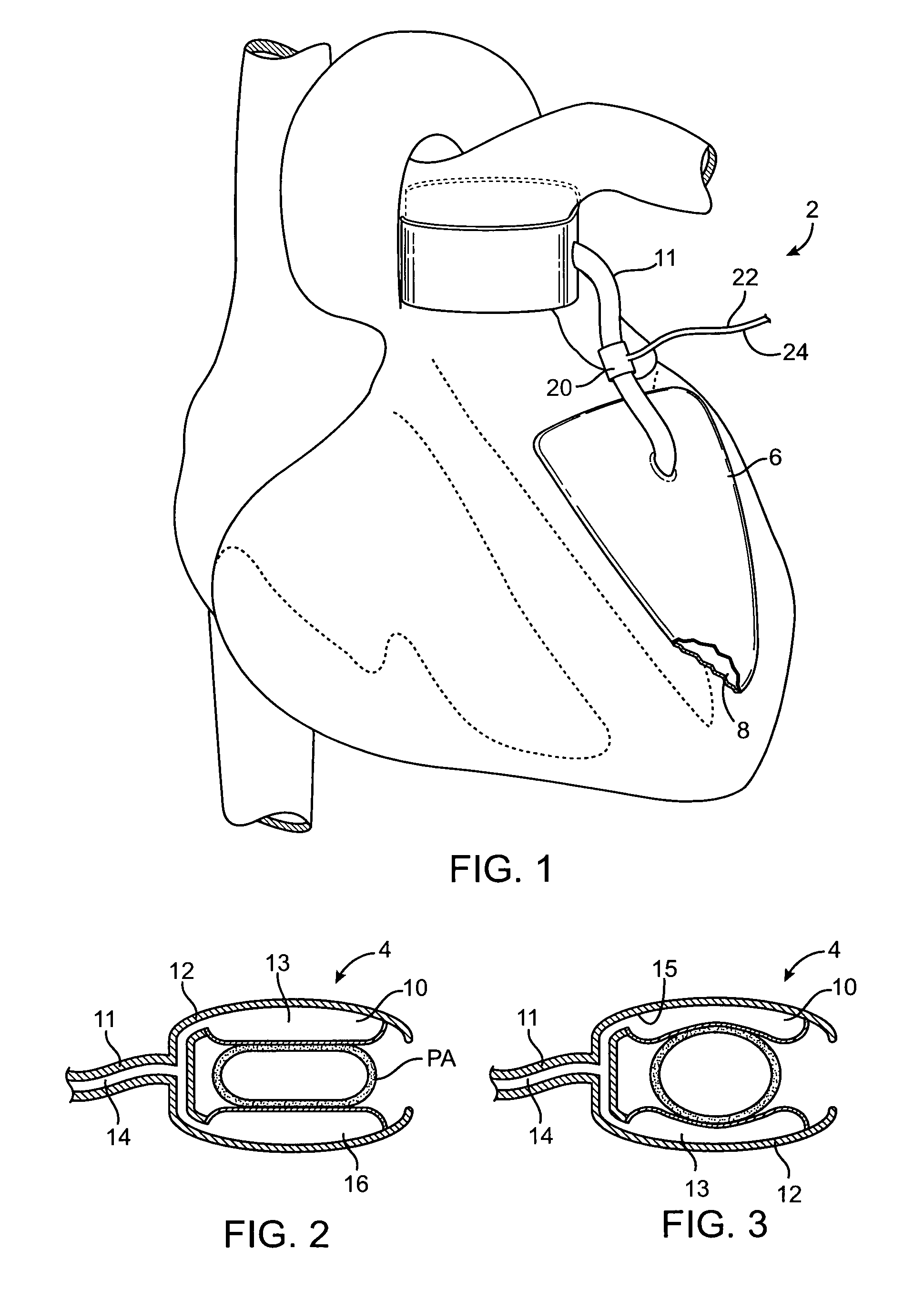 Devices and methods for absorbing, transferring and delivering heart energy